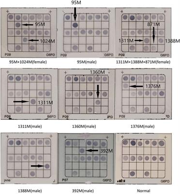 Molecular epidemiological investigation of G6PD deficiency in Yangjiang region, western Guangdong province